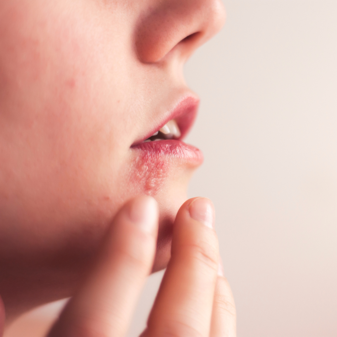 Rating Cold Sore Treatments: A Comprehensive Guide to Managing Outbreaks